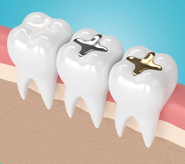 Omaha Composite Fillings