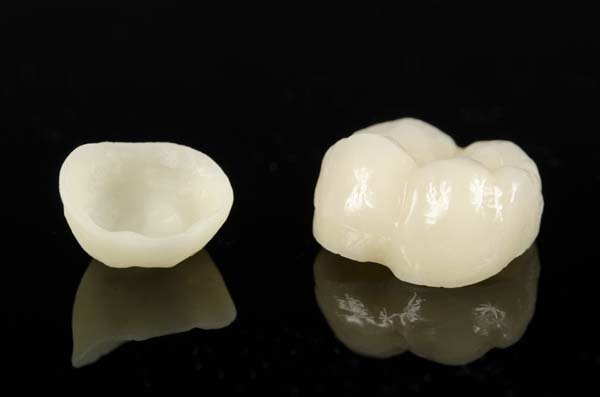 How A Dental Crown Can Improve Your Smile