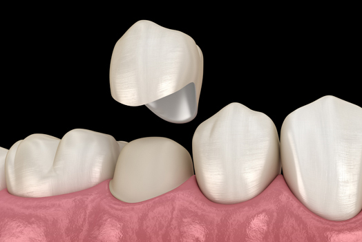 Should I Be Concerned About A Black Line Around My Dental Crown?