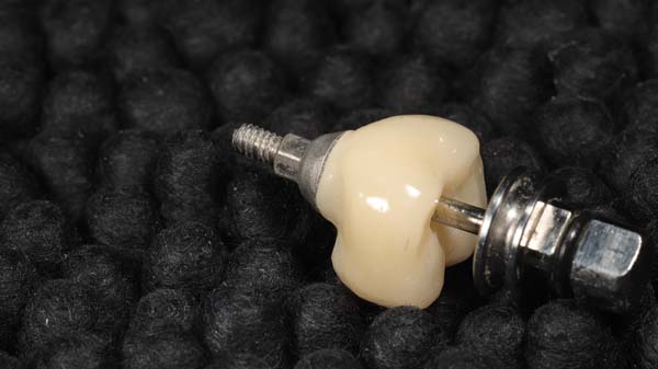Understanding The Dental Implant Process