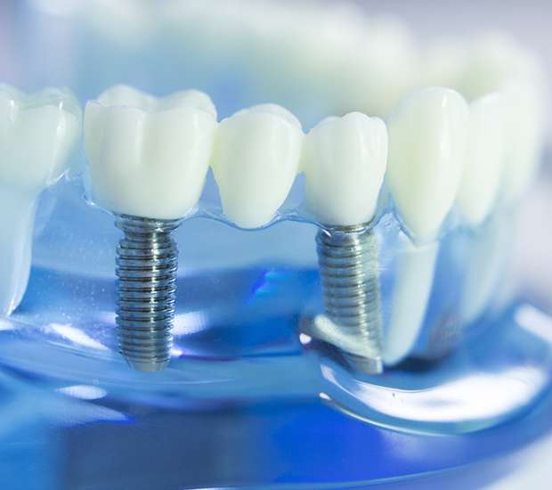 Omaha Dental Implants