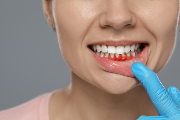Gingivitis To Periodontitis: The Stages Of Gum Disease